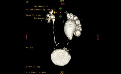 Modified robotic-assisted laparoscopic pyeloplasty in children for ureteropelvic junction obstruction with long proximal ureteral stricture: The “double-flap” technique